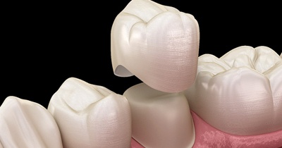 3D render of dental crown capping a tooth