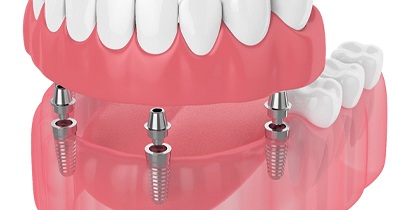 Diagram of implant dentures in Grafton on white background