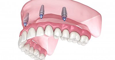 a 3D depiction of implant dentures
