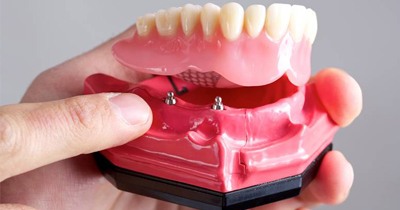 Model of implant denture