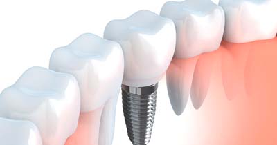 Diagram showing how a dental implant works in Grafton