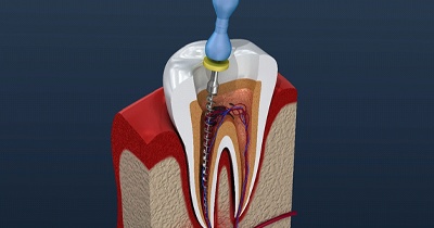 root canal