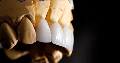 a model of a mouth with dental veneers on the teeth