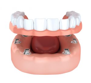 implant detained dentures 3D