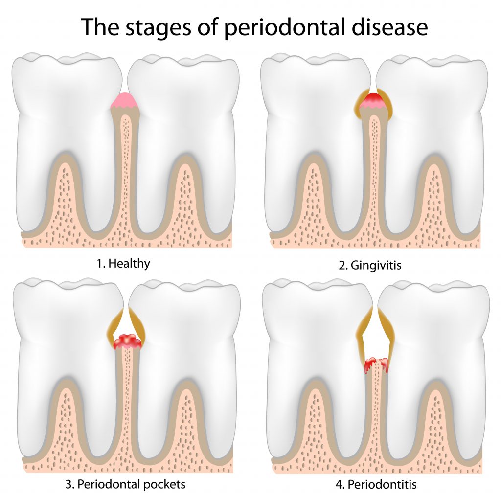 Illustration showing the stages of gum disease