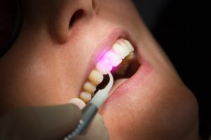 Laser gum disease therapy