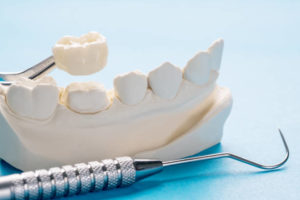Dental model showing a tooth prepped for a crown