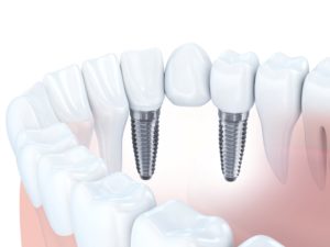 Digital model of an implant-supported bridge