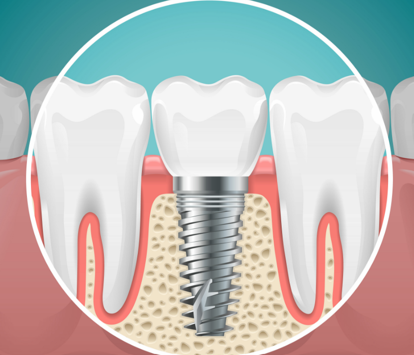 Illustrated cross section of dental implant